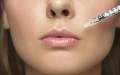 Die Vorteile von Juvederm Ultra Smile: Was Sie wissen müssen